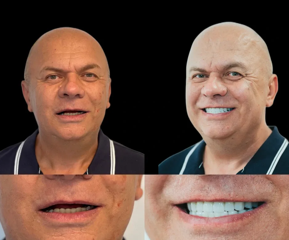 Pacienți Dental Chic Cluj-Napoca, înainte și după tratament