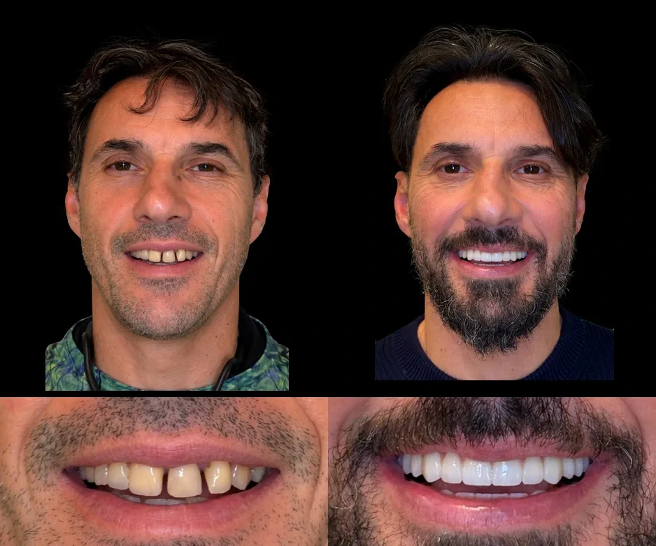 Pacienți Dental Chic Cluj-Napoca, înainte și după tratament