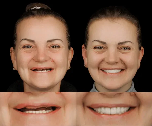 Pacient Dental Chic Cluj-Napoca înainte și după tratament, cazul 2