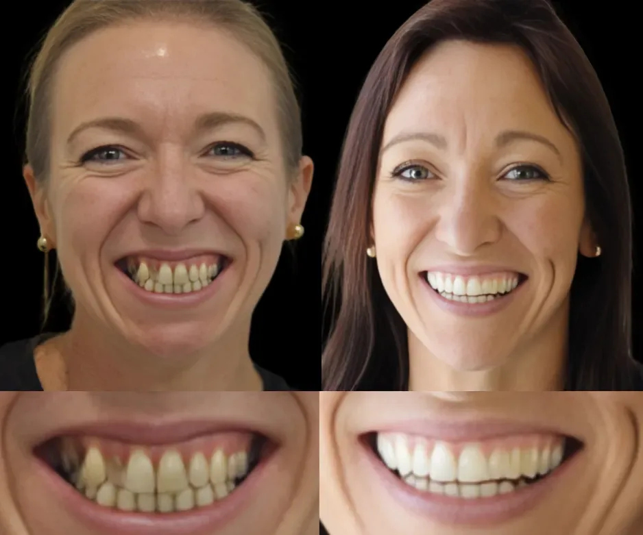 Pacient Dental Chic Cluj-Napoca înainte și după tratament, cazul 3