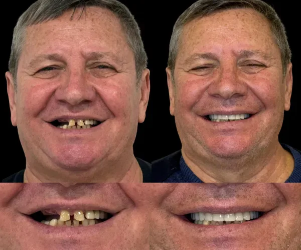 Pacient Dental Chic Cluj-Napoca înainte și după tratament, cazul 4