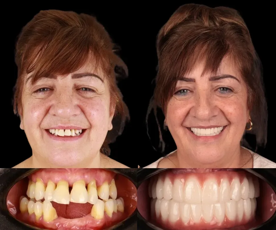 Pacienți Dental Chic Cluj-Napoca, înainte și după tratament