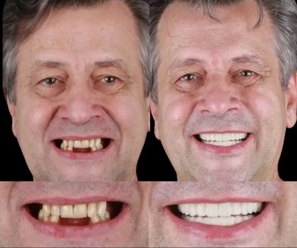 Pacient Dental Chic Cluj-Napoca înainte și după tratament, cazul 7