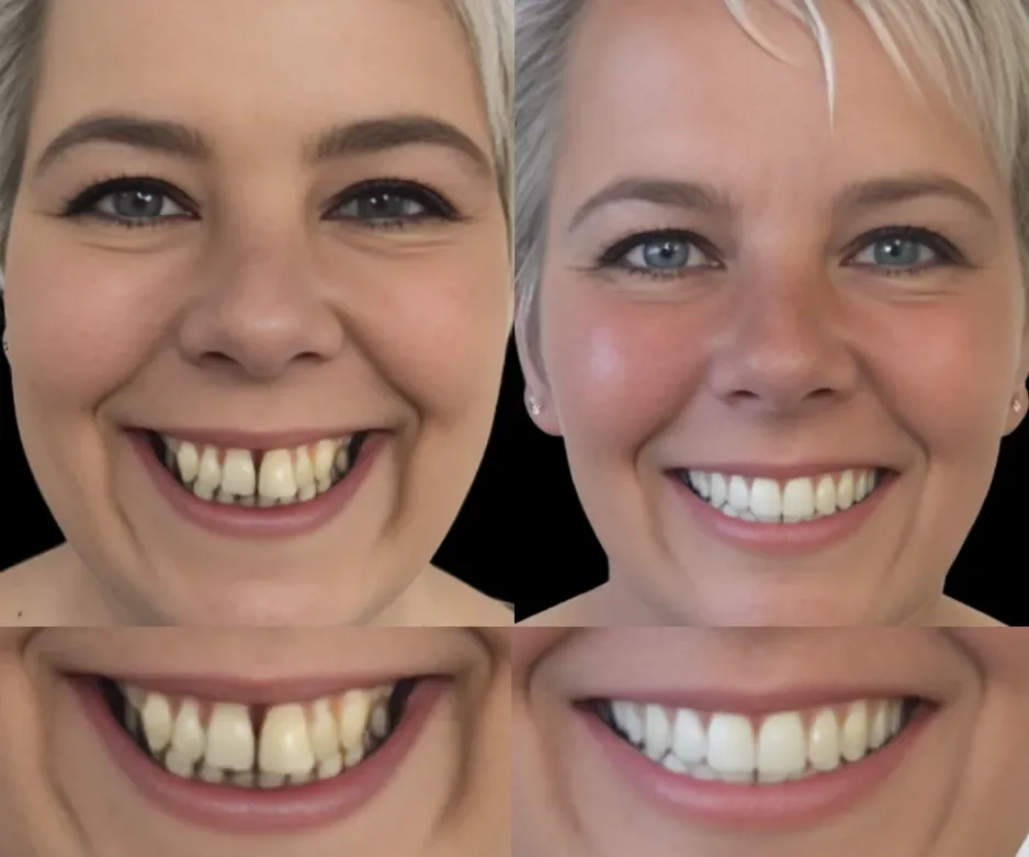 Pacient Dental Chic Cluj-Napoca înainte și după tratament, cazul 9