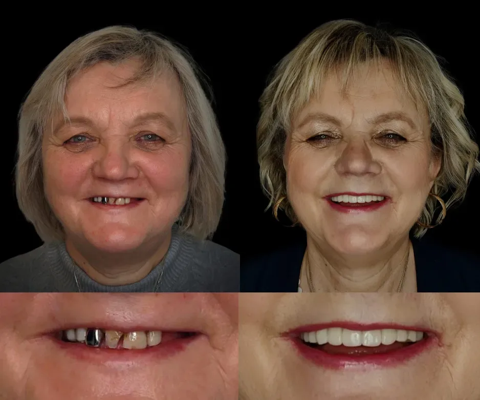 Pacienți Dental Chic Cluj-Napoca, înainte și după tratament