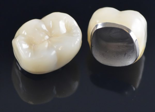implant dentar Cluj, proteza pe implant