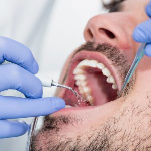 tratament endodontic, endodontie Cluj