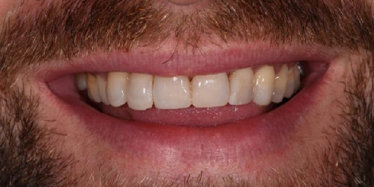 implant dentar Cluj, protetica dentara