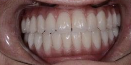 reabilitare orala Cluj, reabilitare dentara complexa