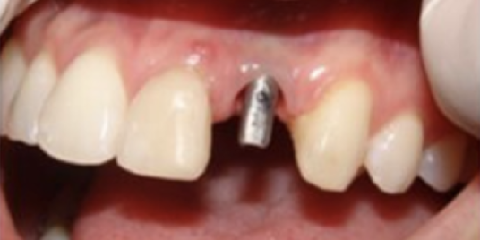 implant dentar pret Cluj, implantologie