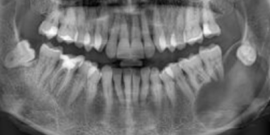 implant dentar Cluj, implanturi dentare Fast & Fixed